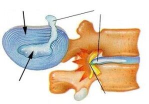 Osteokondrosis cervikoarekin zuntz eraztuna suntsitzea