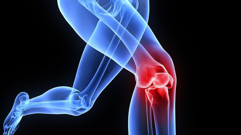 artrosiaren ondorioz belaunen arazoak