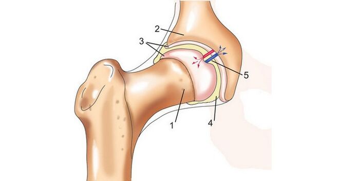 aldakako artikulazioa eta artrosia