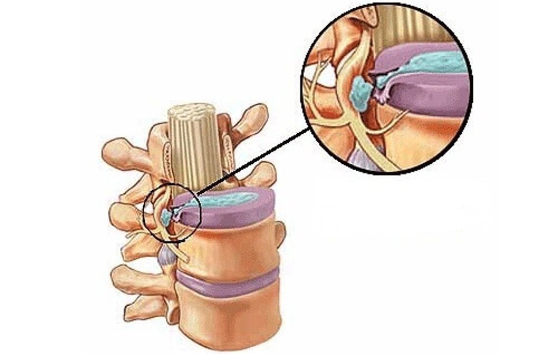 orno arteko hernia toraziko osteokondrosiarekin